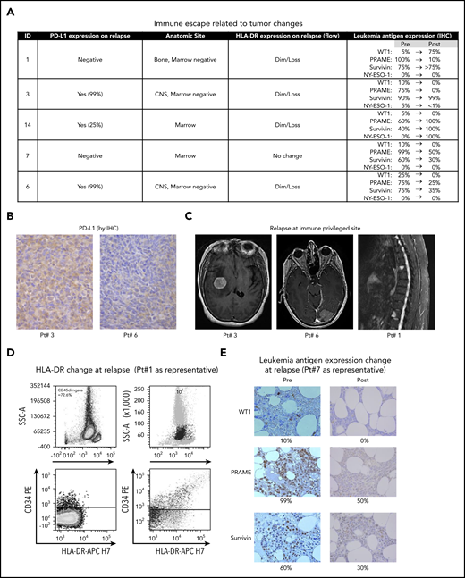 Mechanisms of immune escape at relapse. (A) Summary of mechanisms of immune escape observed in each relapsing patient. (B) Expression of PD-L1 as estimated by IHC in relapsing tumors obtained from patients 3 and 6. Original magnification ×400. (C) MRI imaging in 3 individuals demonstrating extramedullary (immune-privileged anatomic site) relapses. (D) Representative flow cytometry plot from patient 1 depicting loss of HLA-DR expression at relapse. (E) Downregulation of expression of target TAAs (WT1, PRAME, Survivin) on relapsing AML/MDS cells in patient 7. IHC; original magnification, ×400.