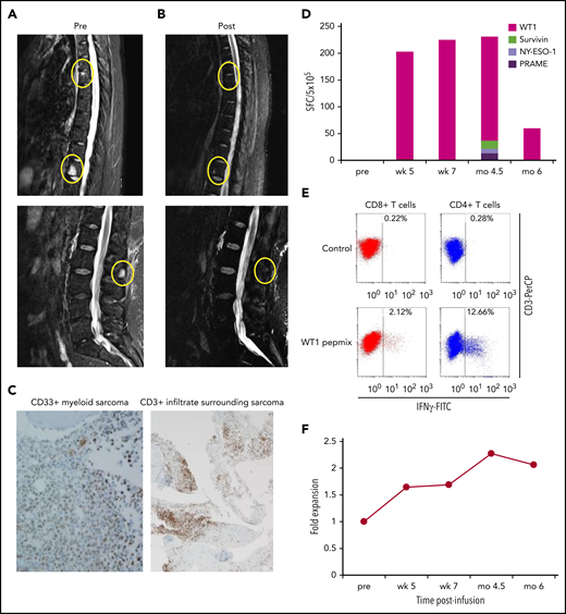 Complete remission from active AML after mLST infusion. MRI images of AML invading bone before (A) and after (B) mLST infusion. (C) Relapsed AML cells (CD33+ blasts; IHC). Hematoxylin and eosin; original magnification ×400. Cells were surrounded by a dense infiltrate of CD3+ T cells. IHC; original magnification ×10. Changes in frequency of circulating mLSTs after infusion, as measured by IFN-γ ELISpot (D) and polyclonality of circulating WT1-specific T cells, as estimated by ICS (E) performed on fresh PBMCs at the 6-month time point. (F) Change in the frequency of mLST-derived TCR clones represented as fold change from baseline in the repertoire frequency.