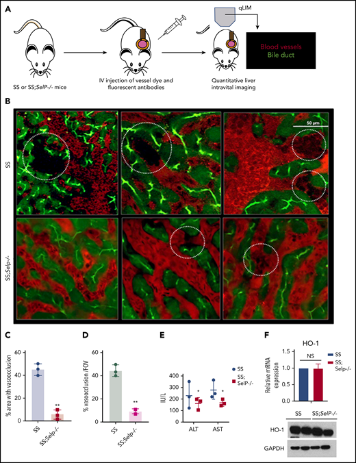 P-selectin–deficient SCD mice exhibit amelioration of ischemic liver injury at baseline. (A) Schematic diagram of qLIM imaging of mice using TXR-dextran and CF to visualize blood flow and bile canaliculi, respectively. (B) qLIM images of 3 different FOVs of SS and P-selectin–deficient SCD liver (SS;Selp−/−) injected with TXR-dextran and CF. Dotted circle shows loss of blood flow in SCD liver, which was significantly improved in SS;Selp−/− liver. Original magnification, ×10; insets, ×20. (C) Quantification of the total area (%) of liver with loss of blood flow in SS and SS;Selp−/− liver. (D) Percentage of total number of vasoocclusion/FOV. (E) Serum alanine aminotransferase (ALT) and aspartate aminotransferase (AST) levels in SS and SS-Selp−/− mice. (F) Quantitative reverse transcription polymerase chain reaction (qRT-PCR) and western blot analysis show comparable amount of HO-1 in SS and SS;Selp−/− liver. *P < .05; **P < .01. GAPDH, glyceraldehyde-3-phosphate dehydrogenase; NS, not significant.
