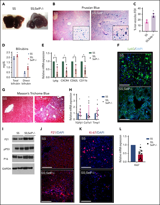 SS-Selp−/− mice exhibit chronic organ injury and exacerbated senescence. (A) Gross specimen of livers of SS and SS-Selp−/− mice. Both the SS and the SS-Selp−/− mice livers were dark and manifested white spots suggestive of progressive injury. (B) Prussian blue staining for iron showed increased iron deposition with a mixed distribution in hepatocytes and Kupffer cells in SS-Selp−/− liver as compared with SS liver. (C) Quantification of iron staining/FOV. (D) Serum direct and total bilirubin levels in SS and SS-Selp−/− mice. (E) Quantitative reverse transcription polymerase chain reaction (qRT-PCR) analysis exhibit reduced mRNA expression of markers of inflammatory cells (including CXCR4, Ly6G, CD11b, and Cd62L) in SS-Selp−/− liver as compared with SS liver. (F) Immunofluorescence for Ly6G showed an increased accumulation in SS mouse liver, which was reduced in SS-Selp−/− liver. Scale bars, 20 µM. (G) Trichome staining of SS and SS-Selp−/− liver sections revealed increased perisinusoidal and periductular fibrosis in SS-Selp−/− liver. Original magnification, ×10. (H) Analysis of mRNA expression by qRT-PCR showed an increase in mRNA expression of TGFβ, Col1A1, and TIMP1 in SS-Selp−/− liver as compared with SS liver. (I) Western blot for P21, P16INK4a, and phosphor-P53 antibodies exhibits increased expression in the liver of SS-Selp−/− as compared with SS. (J) IF of P21 exhibits significant enrichment in SS-Selp−/− liver as compared with SS liver. DAPI, 4′,6-diamidino-2-phenylindole. (K) IF of Ki-67 exhibits reduced hepatocyte proliferation in SS-Selp−/− liver as compared with SS liver. Scale bars, 20 μm (J-K). (L) qRT-PCR analysis of SS and SS-Selp−/− liver exhibits reduced expression of Ki-67 in SS-Selp−/− liver as compared with SS. *P < .05.