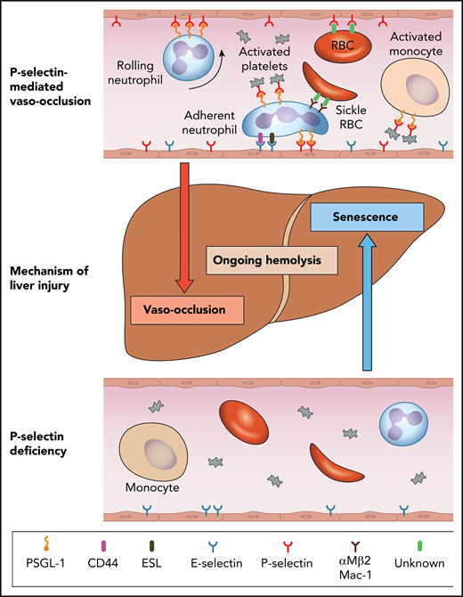 Model for mechanisms of liver injury in SCD as it relates to P-selectin deficiency. The top panel shows the role of P-selectin in mediating multicellular adhesive interactions leading to liver injury by vaso-occlusion. The bottom panel shows that the absence of P-selectin results in amelioration of these adhesive effects and lack of leukocyte recruitment to the endothelium, which lead to liver injury by senescence. Hemolysis is not improved by P-selectin deficiency. ESL, E-selectin ligand; PSGL-1, P-selectin glycoprotein ligand-1; RBC, red blood cell. Professional illustration by Patrick Lane, ScEYEnce Studios.