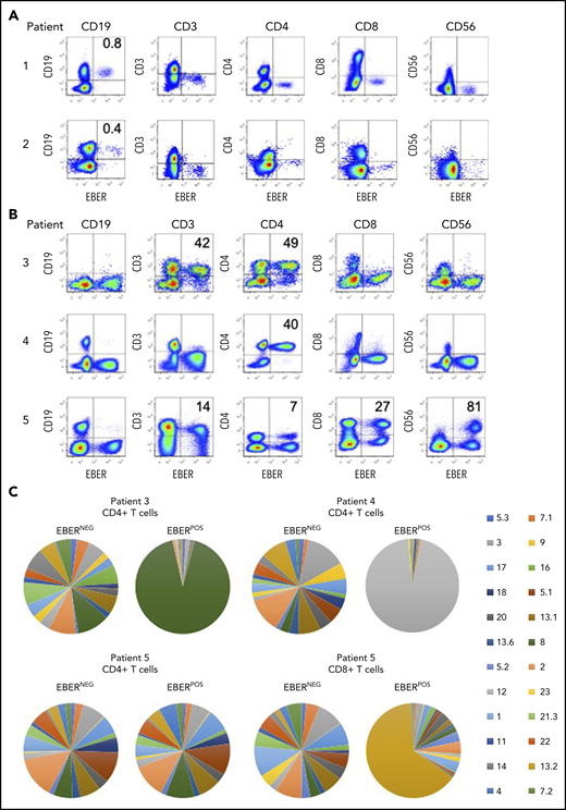 Identification of EBV-infected lymphocytes and clonality in the peripheral blood of patients. (A) Multicolor FlowRNA cytometric analysis of PBMCs from patients 1 and 2 revealed EBV infection of CD19+ B cells. (B) FlowRNA analysis of PBMC from patients 3, 4, and 5 revealed EBV infection of CD4+ T cells from patient 3 and 4, and EBV infection of CD56high NK cells, CD4+ and CD8+ T cells. The analysis also revealed downregulation of CD3 expression in the EBERPOS across patients 3 to 5. The percentage of total lymphocyte subsets expressing EBERs is given in the upper righthand quadrant. (C) T cells were stained with a panel of 24 antibodies against the TCR-BV epitopes and analyzed by flow cytometry. The percentage of T cells expressing each TCR-BV are represented by Venn diagrams. For patients 3, 4, and 5, all EBERNEG T cells exhibited polyclonal TCR-BV populations. However, the EBERPOS CD4+ T cells from patients 3 and 4 exhibited a large monoclonal TCR-BV expansion (TCR-BV8 for patient 3 and TCR-BV12 for patient 4). In contrast, EBERPOS CD4+ T cells from patient 5 exhibited a polyclonal TCR-BV population, whereas the CD8+ T cell exhibited a more focused TCR-BV population (TCR-BV13.2). Key: TCR-BV usage.