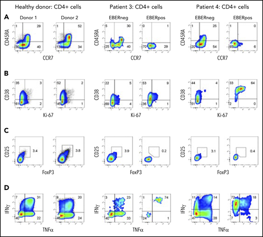 EBERPOS and EBERNEG cells exhibit differences in their phenotype and function. (A) EBERPOS and EBERNEG CD4 T cells from patients 3 and 4 were stained for CCR7 and CD45RA, (B) Ki-67 and CD38, (C) Foxp3 and CD25, and (D) TNF-α and IFN-γ. Age-matched healthy donors were also analyzed; 2 representative donors are shown. The analysis revealed the EBERPOS cell expressed markers consistent with memory T cells: they were activated and proliferative, they were not Tregs, and they expressed significant amounts of proinflammatory cytokines. In contrast, the EBERNEG CD4+ T cells closely resembled the phenotype and function of the healthy donor CD4+ T cells.