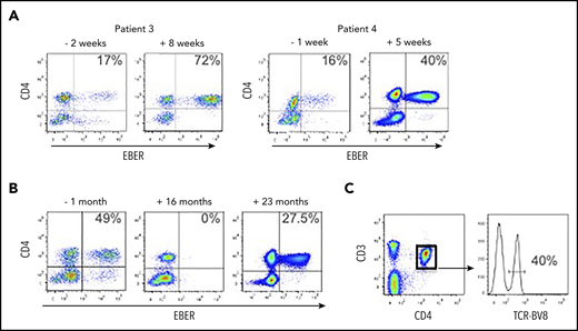 EBV-infected CD4+ T cells are resistant to conventional treatment regimens for CAEBV and HLH. (A) FlowRNA was performed on patient PBMCs to monitor outcome following treatment; both pre- and posttreatment samples are shown for patients 3 and 4. The percentage of EBERPOS CD4+ T cells is shown in the upper right quadrant. The analyses revealed an increase in the number of EBV-infected CD4+ T cells following treatment. (B) FlowRNA performed on PBMCs from patient 3, 1 month before HSCT (−1 month) and 16 months post-HSCT, shows a sustained loss of EBERPOS lymphocytes. However, analysis at 23 months post-HSCT revealed a significant population of EBERPOS CD4+ T cells. The percentage of EBERPOS CD4+ T cells is shown in the upper right quadrant. (C) Analysis of the EBERPOS CD4+ T cells identified at 23 months revealed the reappearance of the EBV-infected TCR-BV8 clone originally identified in the first sample.