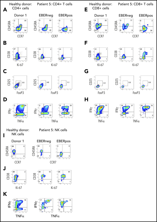 Phenotype and function of EBERPOS T and NK cells from patient 5. FlowRNA analysis of EBERPOS and EBERNEG CD4+ and CD8+ T cells from patient 5. PBMC were stained for CCR7 and CD45RA (A,E), Ki-67 and CD38 (B,F), Foxp3 and CD25 (C,G), and TNF-α and IFN-γ (D,H). Age-matched healthy donors were also analyzed; 1 representative donor is shown. The phenotype and function of the EBERPOS CD4+ T cells closely resembled that of the EBERNEG CD4+ T cells and the healthy donors. The EBERPOS CD8+ T cells were more activated and all expressed IFN-γ and TNF-α. Total NK cells from patient 5 were stained for CD45RA and CCR7 I) (C), Ki-67 and CD38 (J), and TNF-α and IFN-γ (K). Analysis of NK cells from 1 representative healthy donor is shown. All the EBERPOS NK cells were highly activated and replicative, and they all expressed IFN-γ.