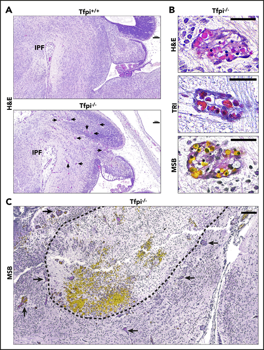 E15.5 sagittal sections of Tfpi−/−brains at the level of the interpeduncular fossa displayed large areas of cellular death and associated hemorrhage surrounded by vascular anomalies called glomeruloid bodies. (A) H&E staining shows that the Tfpi+/+ brain fills the entire cavity of the skull, while the Tfpi−/− brain is smaller and underdeveloped, with a large space between the brain and the calvarium. Arrows identify enlarged congested blood vessels in the Tfpi−/− brain (scale bars, 100 µm). IPF, interpeduncular fossa. (B) High magnification of the enlarged congested vessels in the Tfpi−/− brain identified them as glomeruloid bodies (scale bars, 30 µm). H&E: a multicompartmental vessel with pink amorphous material suggestive of fibrin clot and lumens containing nucleated RBCs. Trichrome (TRI): a multicompartmental vessel with septa containing collagen and nucleated RBCs within the lumens. MSB: a multicompartmental vessel containing numerous yellow nucleated RBCs and pink to red fibrin lining the lumens. (C) MSB staining highlighted the brain pathology of Tfpi−/− embryos. The dotted black line encircles a large area of cell death (pyknotic nuclei and loss of parenchyma) and hemorrhage (pools of yellow-stained nucleated RBCs). Arrows identify numerous glomeruloid bodies surrounding the area of necrosis and hemorrhage (scale bar, 100 µm).