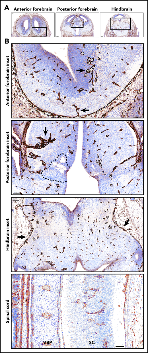 Glomeruloid bodies were present in the forebrain, hindbrain, and spinal cord of E14 Tfpi−/−brain. (A) Coronal sections of anterior forebrain, posterior forebrain, and hindbrain stained for laminin revealed glomeruloid bodies throughout the brain parenchyma. In the sections shown, the anterior forebrain section was at the beginning of the lateral ganglionic eminence. The posterior forebrain section was near its junction with the midbrain as indicated by the presence of the aqueduct of Sylvius, lateral ventricle, choroid plexus, and third ventricle. The hindbrain section was at the level of the aqueduct of Sylvius and fourth ventricle. (B) Magnification of the boxed areas in panel A. Anterior forebrain inset: glomeruloid bodies were present at the bottom of the brain entering from the pial vasculature and in the subventricular zone adjacent to the lateral ventricle (arrows) (scale bar, 60 µm). Posterior forebrain inset: glomeruloid bodies were present throughout the brain parenchyma and adjacent to areas of cell death (dotted black line). Large glomerular bodies originate from pial vessels adjacent to the lateral ventricle (arrow) (scale bar, 80 µm). Hindbrain inset: glomeruloid bodies were present throughout the parenchyma, and pial vessels at the pia-brain interface were disorganized (arrows) (scale bar, 100 µm). Glomeruloid bodies were present in the spinal cord (SC). Adjacent to the spinal cord is the vertebral body primordium (VBP) (scale bar, 100 µm). Corresponding coronal sections from a Tfpi+/+ littermate are presented in supplemental Figure 2.