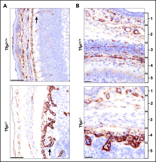 The pial vessels in the Tfpi−/−embryos were disorganized and produced glomeruloid bodies upon penetrating into the brain parenchyma. Meninges and pial vessels of E16 Tfpi+/+ and Tfpi−/− littermates stained for laminin. (A) The meninges of the Tfpi+/+ brain are well organized with normal vasculature seen entering the brain parenchyma (arrow). A prominent feature of the Tfpi−/− meninges is the large layer of abnormal vascular endothelial cells piled up in the pia mater that formed glomeruloid bodies upon entering the brain parenchyma (arrow) (scale bars, 100 µm). (B) The meningeal layers are identified by numbered brackets: (1) skeletogenous layer of the future skull, (2) dura mater, (3) arachnoid mater, (4) pia mater, and (5) brain parenchyma. Formation of the meninges was delayed in Tfpi−/− embryos when compared with Tfpi+/+ littermates. Vasculature was absent in the arachnoid layer of Tfpi−/− embryos, which lacks definition of the impermeable outer layer that prevents passage of cerebrospinal fluid from the subarachnoid space (scale bars, 30 µm).