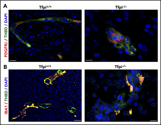 Pericytes and microglial cells were present within glomeruloid bodies in the E15.5 Tfpi−/−brain. (A) Immunofluorescence of brain vasculature from littermates stained for PDGFR-β (red) and thrombomodulin (green), with DAPI-stained nuclei (blue). Occasional pericytes (red) were present along vasculature within the Tfpi+/+ brain parenchyma. The glomeruloid bodies within the Tfpi−/− embryo had numerous pericytes associated with the aggregated endothelial cells (scale bars, 10 µm). (B) Immunofluorescence of brain vasculature from littermates stained for ionized calcium-binding adapter molecule 1 (IBA1; red/yellow) and thrombomodulin (green), with DAPI-stained nuclei (blue). IBA1-expressing microglial cells were associated with endothelial cells in Tfpi+/+ and Tfpi−/− embryos, with no discernible differences between genotypes (scale bars, 10 µm).