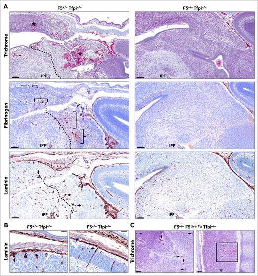 E15.5 Tfpi−/−embryos lacking FV had normal cerebral vasculature. (A) Trichrome-stained midbrain from a F5+/−Tfpi−/− embryo had a large area of hemorrhage (asterisk) and necrosis surrounded by glomeruloid bodies, essentially identical to that observed in Tfpi−/− embryos. In contrast, F5−/−Tfpi−/− embryos had normal brain vasculature without evidence of glomeruloid bodies, hemorrhage, or cellular death. Glomeruloid bodies were seen surrounded by fibrinogen (brackets) leaking from the abnormal vessels. The dotted line delineated the brain tissue with massive cell death (right) from that of the living cells (left). Normal architecture of the F5−/−Tfpi−/− embryo brain displayed normal vasculature without fibrinogen leakage. Laminin staining of the F5+/−Tfpi−/− brain revealed numerous glomeruloid bodies throughout the brain parenchyma (arrows point to 3 glomeruloid bodies). The dotted line delineates cell death (right) from living cells (left). The F5−/−Tfpi−/− brain had normal vasculature with laminin-stained basement membrane. Scale bars, 100 µm. (B) Trichrome stain of pial vessels (arrows) penetrating the brain parenchyma in the F5+/−Tfpi−/− embryo (left) and F5−/−Tfpi−/− embryo (right). The penetrating vasculature of the F5+/−Tfpi−/− embryo revealed glomeruloid bodies advancing from the disorganized pia mater, while the vasculature from the F5−/−Tfpi−/− embryo is organized with parallel walls (scale bar, 50 µm). (C) Trichrome-stained sections from F5−/−Tfpi−/− embryos carrying the F5LiverTg. Rare glomeruloid bodies were observed in the midbrain of one embryo (arrows) and spinal cord of another embryo (sc; square). Minor hemorrhage is present in the spinal cord but is not associated with cell death or inflammation. No pathology was observed in 3 other F5−/−F5LiverTgTfpi−/− embryos (scale bar, 100 µm).