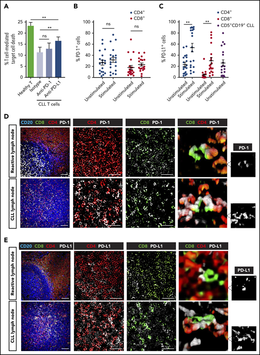 Partial T-cell responses to anti-PD-1 or anti-PD-L1 alone and evidence of a noninflamed TME in CLL. (A) Autologous T-cell killing function against patient CLL cells pulsed with superantigen (sAg) (target cells) (n = 10) as detected by cytotoxicity assays following treatment with isotype control antibody (Ab), anti-PD-1, or anti-PD-L1 blocking Abs. Data presented as mean ± standard error of the mean (SEM). Aged-matched healthy donor T cell activity against autologous B cells pulsed with sAg (target cells) was included as controls. Percentage positive PD-1+ cells (B) and PD-L1+ cells (C) on unstimulated or anti-CD3 + anti-CD28 stimulated patient T cells (CD4+, CD8+) (n = 19). PD-L1 expression on freshly isolated CD5+ CD19+ CLL cells is also shown in panel C. Representative multispectral immunofluorescence images of nonmalignant reactive (n = 5) or CLL/SLL (n = 34) lymph node formalin-fixed paraffin-embedded biopsy tissues for (D) PD-1 (white) and (E) PD-L1 (white) expression on T cells (CD4, red; CD8, green) and B cells (CD20, blue). Original magnification, ×20 medial optical section images (far left, scale bar = 100 μm), cropped images (middle panels, scale bars = 50 μm) and 3D volume rendered confocal images of intercellular PD-1+ or PD-L1+ T-cell interactions (far right) (cropped, ×20 images). **P < .01; ns, not significant using a repeated measures 1-way ANOVA with Tukey's multiple comparisons test (or an unpaired t test for comparing CLL T-cell activity with healthy donor T cells) (A) and Wilcoxon signed-rank tests for comparisons between unstimulated and stimulated T-cell subsets (B-C). Data presented as mean ± SEM.