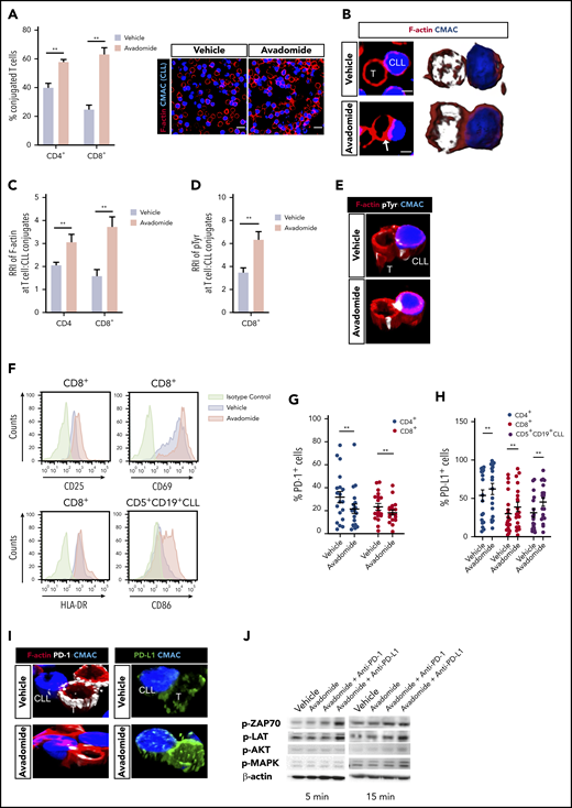 Avadomide activates previously exhausted CLL patient T cells and induces expression of PD-L1. (A) Intercellular autologous CD4+ or CD8+ T-cell:tumor cell conjugates formed from vehicle- or avadomide-treated CLL patient samples (n = 25). Image analysis data presented as mean % T cell:CLL conjugates ± SEM. Representative confocal images show patient T cell:CLL cell (blue) conjugate F-actin (red) interactions after treatment. Original magnification, ×63 (scale bars: 10 μm). (B) Representative medial optical section (scale bars: 5 μm) and 3D volume rendered images of CD8+ T-cell conjugates with increased F-actin (red) immune synapse formation with CLL tumor cells (arrow) following avadomide treatment. Relative recruitment index, RRI image analysis of (C) F-actin (red) and (D) tyrosine-phosphorylated protein polarization in autologous CD4+ or CD8+ T cell:CLL conjugates following vehicle or avadomide treatment (n = 30). (E) Representative 3D volume rendered images of CD8+ T-cell conjugates showing increased phosphotyrosine signal (white, pTyr) at synapses with avadomide. (F) Representative flow cytometric histograms of CD25 and CD69 (top) and HLA-DR (bottom) expression on stimulated patient CD8+ T cells with treatment (n = 5). CD86 expression on treated CD5+ CD19+ CLL cells is also shown. Frequency of (G) PD-1- and (H) PD-L1-expressing cells (stimulated CD4+, blue; CD8+, red; or CD5+ CD19+ CLL cells, black) following avadomide treatment (n = 19). (I) Representative 3D volume rendered images of CD8+ T cell:tumor (blue) conjugates showing reduced and increased expression of PD-1 (white) and PD-L1 (green), respectively, with both molecules polarizing at synapses with avadomide. (J) Representative immunoblots of pretreated (as indicated), stimulated patient T cells subsequently conjugated with MEC-1 tumor cells (T cell:tumor cell conjugates, 5 and 15 minutes for early and late conjugation times, respectively) probed for the phospho (p)-proteins p-ZAP-70, p-LAT, p-MAPK, and p-AKT (n = 3). **P < .01 using Wilcoxon signed-rank tests (A,C-D,G-H). Data presented as mean ± SEM. RRI, relative recruitment index.