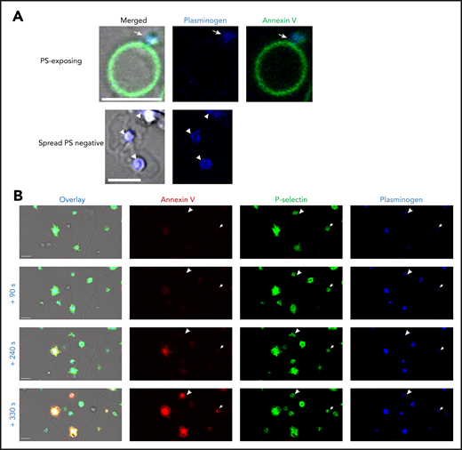 Platelet-derived plasminogen is retained in a distinct pattern on activated platelets. Platelets (0.5 × 108 platelets/mL) were stimulated on a collagen (0.6 µg)- and thrombin (3 pmol)-coated surface stained with (A) Annexin V-AF488 and anti-plasminogen antibody DL633. Arrow indicates plasminogen in the platelet cap. Arrowheads indicate plasminogen over the granulomere. (B) Time course of platelet activation. Platelets are labeled with Annexin V-AF568, AF488 P-selectin antibody, and anti-plasminogen antibody DL633. Arrowheads indicate the single platelets at different time points. Scale bars, 5 μm; representative images of n ≥ 3.