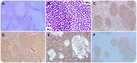 A 57-year-old man with chronic lymphocytic leukemia/small lymphocytic lymphoma (CLL/SLL) and no prior therapy, presented with lymphadenopathy and white blood cell count of 275.2 × 109/L. A lymph node biopsy showed nodular infiltrates of centrocyte-like cells and diffuse small lymphocytes (panels A and B; hematoxylin and eosin stain, 4× and 100× objective; original magnification, ×40 and ×1000, respectively). The small lymphocytes were CD79adim+, CD5+, CD23+, and cyclin D1−; the nodular infiltrates were CD79abright+, CD5+, CD23−, and cyclin D1+ (panels C-F, respectively; 4× objective; original magnification ×40). Flow cytometry detected 2 B-cell populations: one was CD20dim+, CD38−, and κ+, and the other was CD20bright+, CD38+, and λ+. Cytogenetics detected 2 distinct clones: one with trisomy 12 and del(13)(q14), and the other with t(11;14)(q13;q32). Polymerase chain reaction revealed 2 distinct clones, one with an IgH rearrangement identical with the original CLL and the other with a different rearrangement. Findings were diagnostic of composite lymphoma (CL): mantle cell lymphoma (MCL) and SLL. The patient was followed up with expectant management and no new treatment was initiated.