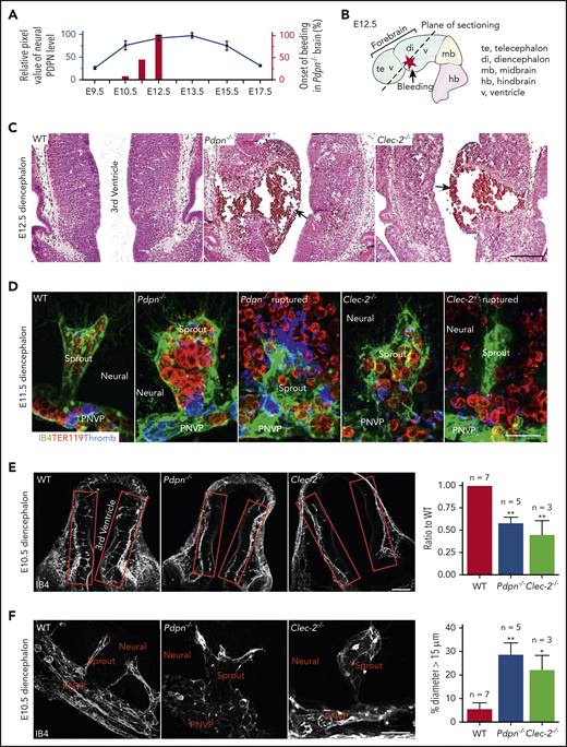 Mice lacking PDPN or CLEC-2 develop aneurysms and spontaneous hemorrhages in the diencephalon at midgestation. (A) Quantification of PDPN expression from confocal images of mouse embryonic diencephalon, with values representing 3 experiments. Bars represent percentages of bleeding onset in the Pdpn−/− diencephalon. (B) The E12.5 mouse brain. (C) Representative images of hematoxylin and eosin–stained embryonic coronal sections of the diencephalon. Arrows indicate aneurysms. (D) Confocal images of lower diencephalon aneurysm-like radial sprouts. IB4 marks the vasculature. TER119 marks erythrocytes. Thromb marks eMks and platelets. Neural, brain tissue. (E) Confocal images of angiogenic sprouting into the diencephalon (red boxes). The bar graph on the right represents the ratio of radial sprouts in the mutant diencephalon compared with the paired WT. (F) Confocal images of aneurysm-like sprouts in the diencephalon. Bar graph on the right represents the percentage of dilated sprouts (>15 μm in diameter) throughout mutant diencephalons relative to WT. Scale bars, 100 μm (C,E); 25 μm (D); and 20 μm (F). Data are means ± standard error of the mean; n, number of embryos. *P < .05; **P < .01.