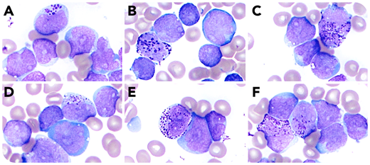 A 14-year-old boy had marked leukocytosis (white blood cell count, 98 000/µL) with circulating blasts, anemia (hemoglobin, 7.1 g/dL) and thrombocytopenia (platelet, 32 000/µL). He has type 1 diabetes mellitus without history of malignancy or hematological diseases. Flow cytometry detected 86% B lymphoblasts. B lymphoblastic leukemia (B-ALL) was considered. On marrow aspirate, basophilic coarse granules were seen in 2% blasts (panels A-F; Jenner-Giemsa stain, 100× objective, original magnification ×1000). When BCR-ABL1 fusion was detected in 94.6% nuclei by fluorescence in situ hybridization, the differential diagnosis expanded to Ph+ B-ALL or chronic myeloid leukemia (CML) blast phase. A blood sample was submitted for cell sorting followed by fluorescence in situ hybridization 6 days after B-ALL induction therapy started. BCR-ABL1 fusion was detected in 75% neutrophils and 90% B-lymphoblasts but not in CD3+ T cells, confirming the diagnosis of CML blast phase. Reverse transcriptase-polymerase chain reaction detected the p190 transcript.