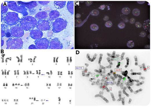 A 75-year-old man with no previous history of hematological disorders presented with 1 week of malaise. Peripheral blood showed leukocytosis with 70% blasts without basophilia or eosinophilia. Bone marrow aspirate revealed 80% blasts with marked vacuolation (panel A; May-Grünwald-Giemsa stain, original magnification ×100). Flow cytometry showed the blasts were CD34+/CD117+/CD13+/CD33+/CD11b+, CD19 dim, cyCD3−/cyCD79a−/CD56−/MPO−. Cytogenetic analysis demonstrated t(9;22)(q34;q11.2), a 3-way t(8;14;21)(q22;q11.2;q22) translocation, and additional numeric abnormalities in all metaphases examined (panel B). Interphase fluorescence in situ hybridization (FISH) was positive for BCR-ABL1 fusion signals in 85% nuclei (panel C; 4′,6-diamidino-2-phenylindole counterstain, original magnification ×1000). Metaphase FISH confirmed the t(8;14;21) and RUNX1-RUNX1T1 fusion on derivative chromosome 8 in all metaphases examined (panel D). Both fusion transcripts were detected by reverse transcription polymerase chain reaction. Next-generation sequencing revealed IDH1 mutation (c.395G>A(p.Arg132His). A diagnosis of acute myeloid leukemia (AML) with BCR-ABL1 and RUNX1-RUNX1T1 was made while noting that blast phase of underlying chronic myeloid leukemia (CML) could not be entirely excluded. The patient was unfit for aggressive chemotherapy and expired after 1 month.
