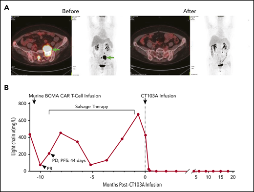 Elimination of myeloma cells by CT103A. (A) Comparison of an extramedullary lesion in the abdomen of patient 01-005 before and 98 days after CT103A infusion. The lesion was denoted by arrows in the left 2 images from the positron emission tomography/computed tomography scan before infusion. At day 98, after infusion, no lesion was observed in the 2 images on the right, which was nearly the same section as that on the positron emission tomography/computed tomography scan. (B) Change in the serum light chain levels in patient 01-001. After the murine BCMA CAR infusion, the serum light chain level decreased for a short time and soon recovered, and the PFS was 44 days. In comparison, after CT103A infusion, the light chain level quickly decreased and remained stable at a normal level with a normal κ/λ ratio, indicating continuous sCR. The PFS was 587 days at the cutoff date.