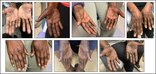 Photographs of typical hyperpigmentation of palms and backs of hands associated with IMiDs.