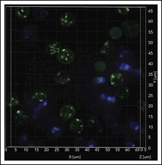 Sickle cell RBCs retain mitochondria. Confocal imaging of blood cells from a patient who was SCD-Baseline stained with mitochondrial (MTG; green), and nuclear (Hoechst; blue) markers. The stained live cells were plated onto 35-mm No. 1.5 poly-d-lysine–coated glass-bottom Petri dishes, and superresolution imaging was performed on the instant SIM. Note that the majority of cells that stained with MTG are anucleate (Hoechst negative). A 3-dimensional superresolution imaging of this figure showing mitochondrial retention in red cells is shown in supplemental Video 1 containing cells that are stained with mitochondrial markers MTG (green), and TMRM (red), markers that stain inactive (depolorized) and active (polarized) mitochondria respectively, and nuclear marker Hoechst (blue).