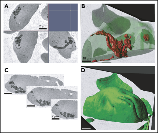 Electron microscopy analysis of SCD RBCs. Ultrastructural analysis of RBCs using electron microscopy. RBCs from patient who was SCD-Baseline were processed using FIB-SEM. (A) Electron micrograph of peripheral blood erythrocytes from a patient with SCD showing mitochondria. Scale bars, 2 μM. (B) Three-dimensional rendering of mitochondria inside the sickle erythrocyte. Image segmented mitochondria are red. Scale bars, 10 μM. (C) Series of image frames from the FIB-SEM image stack. Slice thickness, 9 nm. Isotropic voxel size, 9 nm. (D) Outward morphology of sickle erythrocyte. Cell periphery, green. Scale bars, 10 μm.