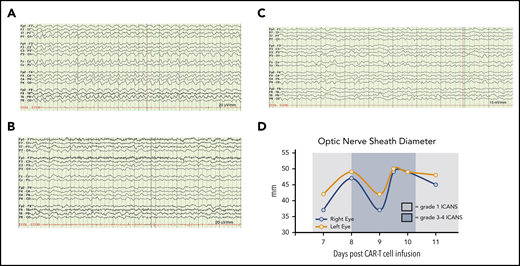 Neurologic monitoring of case 1 during grade 3-4 ICANS. (A) Continuous vEEG showed generalized 2.5 Hz δ activity with a triphasic morphology. (B) Electrographic resolution of seizures on vEEG after empiric lorazepam. (C) Continued electrographic resolution of seizures after treatment with levetiracetam, lacosamide, and rimiducid. (D) Optic nerve sheath diameter tracings before and after rimiducid were within the normal range and not indicative of elevated intracranial pressure. A cutoff of >5.5 mm was used to indicate possibly elevated intracranial pressure.