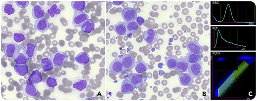 A 46-year-old woman presented acutely unwell with high blast count acute monoblastic leukemia (AML; white cell count, 321.6 × 109/L; hemoglobin, 89 g/L; platelet count, 56 × 109/L). At 6 hours post cytoreductive therapy, she developed tumor lysis syndrome, as defined by the Cairo-Bishop criteria, requiring management with rasbirucase and renal replacement therapy. A full blood count at this point showed an unexpected increase in the platelet count to 375 × 109/L using the impedance method (PLT-I) and 360 × 109/L using the fluorescent platelet channel (PLT-F) on the Sysmex XN-20 (Kobe, Japan). Her blood film showed new frequent small basophilic bodies, some containing pyknotic nuclei (panel A, before treatment; panel B, after treatment; Wright stain, 40× objective; total magnification ×400). These leukemic fragments developed after therapy and were indistinguishable from platelets not only by PLT-I but also by PLT-F (panel C; PLT-I histogram and PLT-F scattergram). The patient received twice daily prophylactic platelet transfusions, as an accurate platelet count could not be obtained by automated or manual means. Unfortunately, despite this, she suffered intracranial hemorrhages and died 72 hours after presentation.