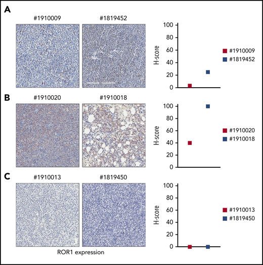 ROR1 expression on primary RS samples. ROR1 expression was analyzed by IHC staining in primary samples of BM or lymph node biopsies from patients with RS using an anti-ROR1 antibody (mouse clone OTI3D11). Slides were scanned using an Aperio AT Turbo system to produce whole slide images. Slides were developed with DAB (3,3'‑diaminobenzidine) and counter-stained with hematoxylin and eosin. (A-C) A .jpeg image of each stain is shown. Original magnification ×20. An H score (range of 0-300) was calculated based on the summation of the product of the percentage of cells stained at each intensity using the following equation: (3 × % cells staining at 3+) + (2 × % cells staining at 2+) + (1 × % cells staining at 1+) to estimate ROR1 expression. ROR1 was heterogeneously expressed, ranging from highly positive to completely negative cases. Primary samples with an intermediate expression of ROR1 (A); with a high expression of ROR1 (B); and with no ROR1 expression (C).