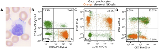 An 82-year-old woman presented with a history of lung and breast cancer, both treated surgically, and persistent asymptomatic lymphocytosis for 8 years. Peripheral blood showed increased large granular lymphocytes without other abnormalities (white blood cell count, 10.5 × 109/L; neutrophils, 47.8%; lymphocytes, 39.8%; monocytes, 8.6%; eosinophil, 3.2%; basophil, 0.6%) (panel A; Wright-Giemsa stain, original magnification ×60 objective, ×600 total magnification). Flow cytometry showed an abnormal natural killer (NK) cell population, 26% of leukocytes (2.7 K/μL), expressing CD56, CD16, subset CD57, minor subset CD7, and negative for CD3, CD2, and CD5 (panels B-D; orange). This NK population was identified 4 years prior and was thought to be due to a “reactive etiology.” Targeted mutational analysis (Stanford Actionable Mutation Panel for Hematopoietic and Lymphoid Malignancies) of the peripheral blood revealed TNFAIP3 p.R278fs, DNMT3A p.? (c.856-2A>G) and TP53 p.P177L mutations with variant allele frequencies of 8%, 22%, and 4%, respectively. Mutations in STAT3 or STAT5B were not identified.