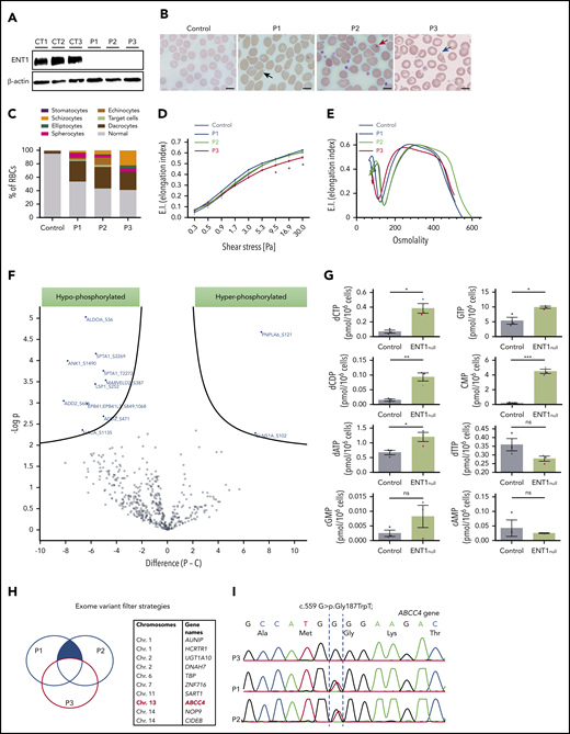 Red cell alterations in ENT1null individuals. (A) Western blot analysis of ENT1 expression in ENT1null RBC membranes from the 3 siblings. β-actin was used as loading control. (B) Blood smears of ENT1null individuals showing a macrocytosis and marked anisopoikilocytosis, characterized by the presence of RBCs with abnormal sizes and morphologies, including elliptocytes (black arrow), dacrocytes (red arrow), and schizocytes (blue arrow). Scale bars, 10 µm. (C) Quantification of the different RBC populations was calculated from 300 RBCs per slide. (D) RBC deformability was assessed by an ektacytometry approach and elongation index relative to shear stress is shown for controls, P1, P2, and P3, and 7 controls. (E) Osmoscan test of ENT1null RBCs from the 3 patients and a healthy control was monitored by ektacytometry. (F) The phosphoproteome of ENT1null (n = 3) and control (n = 5) RBC membranes was evaluated. Each dot represents a phosphorylated protein, with blue dots corresponding to significantly hypophosphorylated (left) and hyperphosphorylated (right) proteins. (G) Nucleotide-targeted metabolomic analysis of ENT1null (n = 3; P1, blue; P2, green; P3, red triangles) and control (n = 3; black circles) RBCs were performed and intracellular levels of deoxynucleotides and cyclic nucleotides (cAMP, cGMP) are shown. (H) Schematic representation of the variant filter strategy used to analyze the exome sequencing of ENT1null patients. Common mutations between P1 and P2, but absent in P3 (blue filled area) were filtered, candidate genes identified, and their chromosomes are shown in the table. (I) Sanger sequencing confirmation of the c.559 G>T; p.Gly187Trp mutation on the ABCC4 gene, showing the absence of the mutation in P3, and its presence in the heterozygous state in P1 and P2.