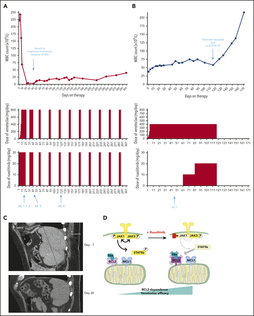 Two patients treated with the venetoclax+ruxolitinib combination. (A) Patient A (top): the curve shows the evolution of white blood cell (WBC) count during treatment with the venetoclax+ruxolitinib combination. The 2 histogram graphs show the daily doses of venetoclax and ruxolitinib received. The combination was started with ruxolitinib 15 mg twice daily and venetoclax 2 days later with a daily ramp-up from 20 to 800 mg over 6 days. Adverse events (AEs): (1) grade 3 urinary infection; (2) grade 3 thrombocytopenia; (3) grade 3 exacerbation of COPD; and (4) grade 3 pneumonia. Because of the repeated infectious AEs and thrombocytopenia, the schedule was modified to an intermittent one, with ruxolitinib 15 mg twice daily given together with venetoclax 400 mg daily for 5 days, at 4-week intervals. (B) Same data for patient B: venetoclax was started first with a daily ramp-up from 20 mg to 800 mg over 6 days. After 2 months of slow progression, ruxolitinib was added at 10 mg/d and then increased to 10 mg twice daily. AE 1: grade 2 thrombocytopenia. (C) A computed tomographic scan of patient A showing the spleen at baseline (largest dimension measured, 168.3 mm) and 1 month after the beginning of treatment with ruxolitinib+venetoclax (largest dimension measured, 110 mm). (D) The proposed mechanism underlying our main findings. At baseline, BCL-2 and MCL-1 are molecular vulnerabilities in T-PLL. JAK/STAT pathway inhibition through JAK1 inhibition selectively increases BCL-2–dependent apoptotic priming and the activity of venetoclax.