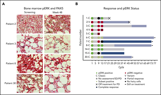 pERK status during treatment and clinical outcome. (A) pERK expression in HCL cells in the bone marrow are shown for 4 representative patients at screening and week 48 of ibrutinib treatment. pERK expression is shown as red cytoplasmic staining. Leukemia cells were identified by a PAX5 stain with brown nuclear staining when present. The use of both stains identifies pERK expression specifically in the leukemia cells. The presence of cytoplasmic pERK is shown with thick arrows and the absence is shown with thin arrows. Patient 2 has vHCL and had a diffuse infiltrate of leukemic cells at both screening and week 48 of treatment. The leukemia cells were negative for pERK staining at every time point tested. Patients with vHCL have previously been shown to not have pERK, and this may not be a prosurvival signal in these patients, given that vHCL and cHCL have relatively different biology. The remaining 3 patients (3, 8, and 30) all have cHCL and a durable benefit from ibrutinib with a PFS of more than 2 years, and all were continuing to receive ibrutinib at the last follow-up. They all had different changes in pERK status after starting treatment. Patient 3 had pERK in the leukemia cells at screening that was absent by week 48, patient 8 had persistent presence of pERK at all time points tested, and patient 30 had a subset of pERK-positive leukemia cells at screening and at week 48. (B) Swimmer’s plot with pERK status at screening, week 32, and week 48 for all patients for whom samples were available. Both patients with vHCL (patient 2 and patient 4) were pERK negative at every time point tested, which is consistent with what was previously described in patients with vHCL. Many patients with persistence of pERK continued to receive ibrutinib without progression for an extended period. This supports that (contrary to what was shown with vemurafenib) the presence of pERK during ibrutinib treatment may not predict a shorter PFS and argues that the mechanism of effect of ibrutinib may not involve decreasing ERK phosphorylation.