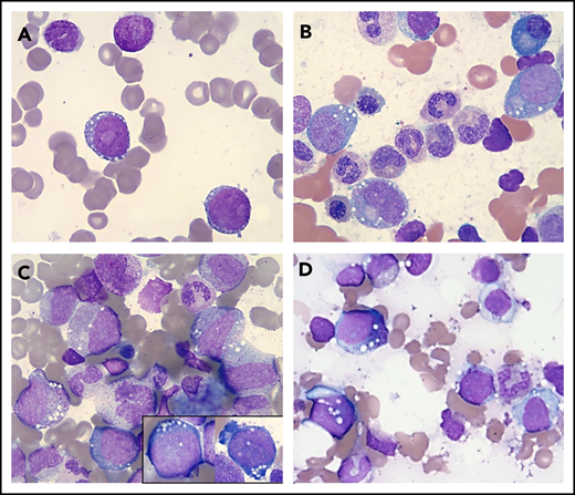 Vacuolization of HPs in various conditions. Wright-Giemsa stains (magnification ×1000) showing a representative example of a "blast-only” pattern of vacuolization in a case with high-risk MDS (vacuoles in 2 blasts) (A) and vacuolization of immature erythroid and myeloid cells in 2 patients with a UBA1 mutation and VEXAS syndrome (B-C) and in a patient with copper deficiency (D).