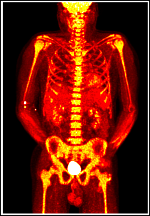 18F-fluorodeoxyglucose positron emission tomography in a patient with VEXAS syndrome demonstrating hypermetabolic activity in bone marrow (yellow). Somatic mutations in UBA1 in hematopoietic cells lead to myeloid-driven inflammation that is often refractory to treatment in patients with VEXAS syndrome.
