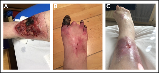 Photographs of right lower limb of patient 2 during disease progression. (A) Leg ulcer due to microvascular thrombosis (confirmed histologically). (B) Progressive gangrene in 3 toes, the 2 other toes having autoamputated. (C) Considerable improvement in the leg ulcer, following multimodal therapies, and the end result of the digital gangrene.