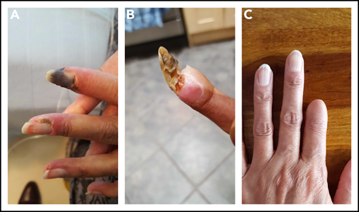 Photographs of disease progression in the left hand of patient 3. The early (A), middle (B), and end (C) phase of this patient’s digital gangrene affecting the index finger.