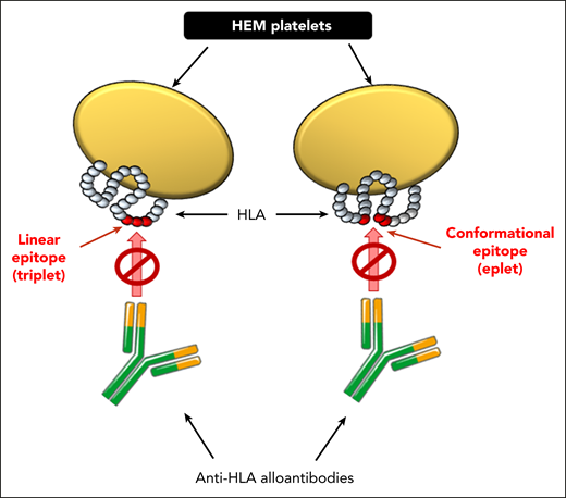 HEM platelet transfusions in HLA alloimmunized patients with platelet refractoriness. Matching at the epitope level occurs by characterizing short sequences of amino acids from linearly consecutive (left; triplet) or discontinuous and spatially close (right; eplet) amino acid residues of the HLA molecules. HEM platelets are expected to not be targeted by pathogenic donor-specific anti-HLA alloantibodies and consequently to not undergo antibody-mediated phagocytic internalization, allowing platelet counts to increase posttransfusion.