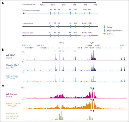 Schematic representation of the human α-globin cluster: characterization of open chromatin and chromatin interaction profiles. (A) Schematic diagrams of the α-globin locus located in the subtelomeric region of chromosome 16. The top track represents the wild-type (WT) locus (αα). The tracks beneath represent the 2 alleles inherited by the patient. For clarity, intervening genes and structural elements are not included. The paternal allele is (αα)ALT and the maternal allele is --SEA. (B) The open chromatin landscape at the α-globin locus (ATAC-seq) in primary erythroid cells on day 13 of erythroid differentiation. The top track is generated from cells derived from 3 unrelated WT controls (αα/αα), the middle is from a carrier of the SEA mutation (αα/--SEA), and the bottom is from the patient (--SEA/(αα)ALT). In the patient’s cells, marked reduction in ATAC signal is observed at the R2 enhancer and the α-globin genes. No new peaks are seen. Genes and pseudogenes are annotated below the scale bar. (C) Chromatin interaction profiles between the α-globin promoters (arrowheads) and the surrounding chromatin in primary erythroid cells (Capture-C). Peaks along the track represent interactions with the α-globin promoters. Although there are increased interactions with chromatin adjacent to the promoters due to proximity effects, in the WT setting, there is a marked increase in interactions with chromatin regions containing the enhancers, even though they lie up to 70-kb away. The top track depicts the mean interaction profile observed in cells from three unrelated WT controls (αα/αα), and the middle track is the interaction profile observed in cells taken from the patient, which shows an absence of interactions between the α-globin promoters and R2, in keeping with its deletion on that allele. The bottom track depicts the reduction in interactions when comparing the patient and the WT controls, represented as log-adjusted P values. There is a highly significant reduction in interactions between the α-globin promoters and R2 because of its deletion, and a modest reduction in interactions between the promoters and R1, R3, and R4. Intersection of the Capture-C, ATAC-seq, and dbSNP data reveals that this reduction in interactions in cis with the deleted R2 is also matched by reduced chromatin accessibility on the same allele at R3 as measured by ATAC-seq (the patient did not have any SNPs in R1 or R4 so these could not be assessed). SNP, single nucleotide polymorphism.