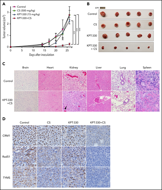 KPT-330+CS shows potent antitumor effect without substantial in vivo organ toxicity. Tumor volume curves (A) and extracted tumor (B) of NSG mice transplanted subcutaneously with JeKo-1 cells and treated with vehicle, KPT-330, CS, or KPT-330+CS. Tumor volumes were measured daily for 26 days. (C) Histopathological assessment of organs from non–tumor-bearing mice treated with KPT-330+CS or vehicle for 26 days (original magnification ×10; hematoxylin and eosin stain). Grade I renal tubular hyperplasia (black arrowhead points to a renal tubule with increased cellularity) was seen in 4 of 5 mice as compared with 1 of 5 mice in the treatment and control groups, respectively. (D) The expression of CRM1, Rad51, and TYMS proteins assessed through immunohistochemistry on tumor tissue following treating tumor-bearing NSG mice with respective drug combinations for 26 days (original magnification ×100). ***P < .0005. The paired Student t test was used to compare all continuous variables. A value of P < .05 was considered statistically significant.