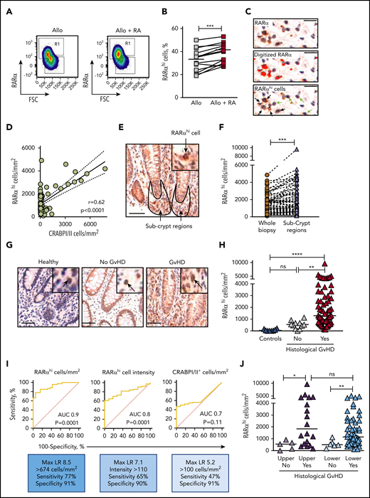 RA-responsive mononuclear cells are increased in areas adjacent to GI-GVHD tissue damage. (A) RARα protein expression measured by flow cytometry in human PBMCs allostimulated in the presence or absence of exogenous RA. Example pseudodot plots are shown. Cells with high expression of RARα are shown in Region 1 (R1). (B) RARα protein expression in human PBMCs allostimulated in the presence or absence of exogenous RA. Results depict 18 independent experiments. (C) Identification of RARαhi mononuclear cells in GI biopsies using IHC staining for RARα (upper panel, brown) with hematoxylin counterstaining (blue). After antigen retrieval, tissue was stained with rabbit anti-human RARα antibody (Clone F-9; Santa Cruz Biotechnology) for 40 minutes at room temperature. Sections were then stained using the Biogenex SuperSensitive Polymer-HRP IHC Kit and diaminobenzidine (DAB) chromogen and were counterstained with hematoxylin. Mononuclear cells were identified by size and nuclear staining characteristics (middle panel, blue dots), and RARα staining intensity was digitized using the Ariol Olympus microscope and automated image analysis system (middle panel, red). A threshold of RARα staining intensity was set to identify cells with high RARα expression (lower panel, yellow dots). RARαhi mononuclear cells (lower panel, black arrows) were distinguished from mononuclear cells with lower expression of RARα (lower panel, green arrows). Scale bars, 10 μm. (D) Correlation between RARαhi mononuclear cell numbers and cellular RA-binding protein CRABPI/II+ cell numbers in upper and lower GI biopsies from allogeneic hematopoietic stem cell transplantation (allo-HSCT) patients. Solid lines denote linear regression and dotted lines denote 95% confidence intervals. P and r values are for Pearson correlation. (E) Representative GI biopsy stained for RARα using conventional IHC and DAB chromogen. Subcrypt regions are outlined in black and are indicated by arrows. Scale bar, 50 μm. (F) Enrichment of RARαhi mononuclear cell numbers enumerated using the Ariol automated system in subcrypt regions of GI biopsies. (G) Representative GI biopsies from healthy controls and allo-HSCT patients with and without histologic GVHD were stained for RARα using conventional IHC and DAB chromogen. Scale bars, 50 μm. Black arrows depict mononuclear cells with high expression of RARα. (H) RARαhi mononuclear cell numbers in subcrypts of GI biopsies from allo-HSCT patients and healthy controls with and without histologic GVHD. (I) Receiver operating characteristic curves for subcrypt RARαhi cell numbers, RARαhi cell intensity, and CRABPI/II+ cell numbers and the presence of histologic GVHD. (J) RARαhi mononuclear cell numbers in subcrypts of upper (left) and lower (right) GI biopsies with and without histologic GVHD. Horizontal lines on graphs depict medians. AUC, area under the curve; FSC, forward scatter; LR, likelihood ratio; ns, not significant. *P < .05; **P < .01; ***P < .001; ****P < .0001, Mann-Whitney U tests (B,F) and analysis of variance (ANOVA) tests with correction for multiple comparisons (H,J).