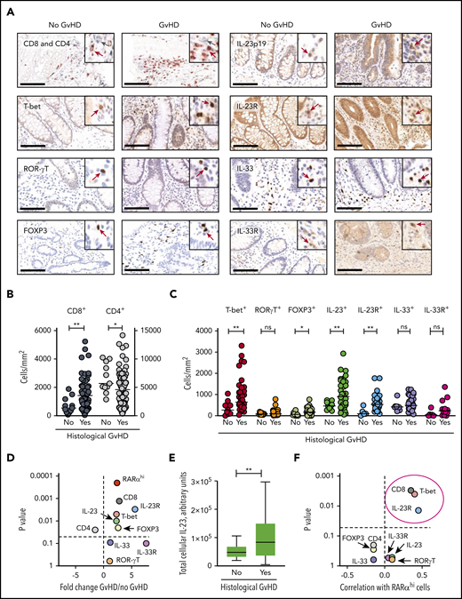 A targeted candidate protein approach identifies a predicted phenotype of RA-responsive cells in the context of increased microenvironmental IL-23. (A) Mononuclear cell staining for T-cell lineage markers, transcription factors, and the cytokines IL-23 and IL-33 and their receptors using conventional IHC in the same GI biopsy cohort. Scale bars, 100 µm. Positive cells (brown) are stained by DAB, SG (CD4) or AEC (CD8) chromogen. Cells are counterstained with hematoxylin. Insets show higher manifaction with positice cells identified with arrows in gray (CD4) or red (all other markers). (B) CD8 and CD4 T-cell numbers were enumerated automatically using the Ariol system in subcrypt regions of upper and lower GI biopsies from allo-HSCT patients with and without histologic GVHD. (C) Mononuclear cell numbers were enumerated automatically using the Ariol system expressing T-cell transcription factors, cytokines, and cytokine receptors in subcrypt regions of upper and lower GI biopsies from allo-HSCT patients with and without histologic GVHD. (D) Volcano plot depicting fold change and statistical significance of RARαhi mononuclear cell numbers and number of cells expressing T-cell lineage markers, transcription factors, cytokines, and cytokine receptors in subcrypt regions of upper and lower GI biopsies from allo-HSCT patients with and without histologic GVHD. (E) Total cellular IL-23 (calculated as the product of the number of IL-23+ mononuclear cells and the mean intensity of staining of cells for IL-23) in subcrypt regions of upper and lower GI biopsies from allo-HSCT patients with and without histologic GVHD. (F) Volcano plot depicting correlation coefficients and statistical significance of numbers of RARαhi mononuclear cells and cells expressing T-cell lineage markers, transcription factors, cytokines, and cytokine receptors in subcrypt regions of upper and lower GI biopsies from allo-HSCT patients. P and r values are for Pearson correlations. Cells expressing CD8, T-bet, and IL-23R (circled) were significantly positively correlated with numbers of RARαhi mononuclear cells. Horizontal lines are medians. P > .10 indicates nonsignificant values. *P < .05; ** P < .01, Mann-Whitney U tests (A-E).