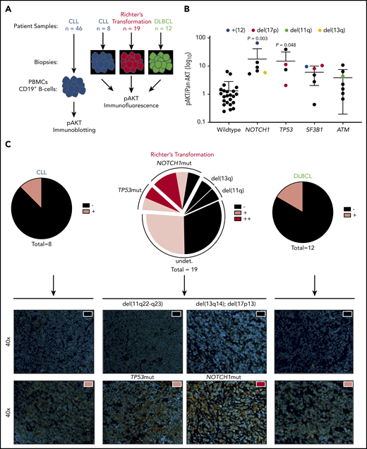 Increased AKT activation in CLL subsets associated with RT and increased frequency in patients with RT. (A) Flow diagram of AKT activation screening setup. (B) Histogram showing pAKT (Ser473)/panAKT expression (AKT activation) from freshly isolated peripheral B cells, in a cohort of patients with CLL stratified according to mutations in NOTCH1, TP53, SF3B1, and ATM (n = 46). Colored dots represent chromosomal aberrations identified via fluorescence in situ hybridization (blue = trisomy12; red = 17p deletion; green = 11q deletion; yellow = 13q deletion). (C) Immunofluorescence imaging of CLL (n = 8), RT (n = 19), and DLBCL (n = 12) for pAKT (Ser473). Proportion of cases defined as negative (black), positive (pink), or double positive (red) shown as pie charts for each entity (upper panel). Representative images from positive and negative cases from each entity (lower panel). All images shown at ×40 magnification. Nuclear staining (4′6-diamidino-2-phenylindole) and pAKT (Ser473) staining shown in orange. Significant differences in AKT activation between wild-type and TP53/NOTCH1/SF3B1/ATM mutated CLL peripheral blood mononuclear cells (PBMCs) by immunoblotting assessed by using one-way analysis of variance, with Tukey multiple comparison correction.