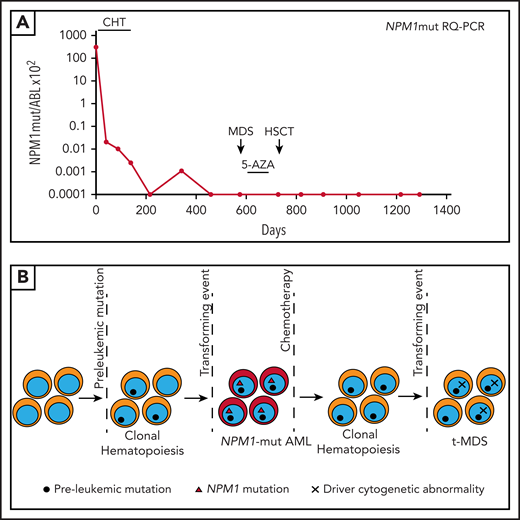 NPM1-mutated AML relapsing as therapy-related MDS. (A) Monitoring of NPM1mut transcripts during therapy and follow-up (see text). 0.0001 is equivalent to MRD negativity. (B) Cartoon depicting the clonal architecture of the BM over time in the patient described in scenario 4. Absence of NPM1 mutations and presence of MRC-related cytogenetic abnormalities at relapse demonstrated the development of a second myeloid neoplasm (t-MDS). 5-AZA, 5-azacitidine; RQ-PCR, RT-qPCR.