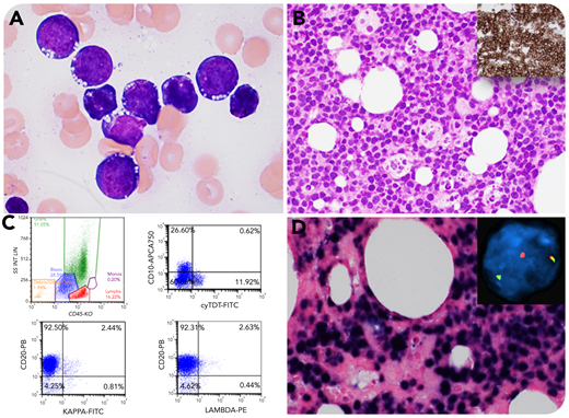 A 68-year-old woman presented with a 6-week history of generalized fatigue, decreased appetite, profound all-day sweating, and 40-pound weight loss. Physical examination revealed no lymphadenopathy or hepatosplenomegaly. Laboratory test results showed normocytic anemia with normal WBC and platelet counts. Magnetic resonance imaging revealed heterogeneous mixed T1 and T2 signal changes but with no solid mass. A bone marrow aspirate showed many blasts with dispersed chromatin and scanty deeply blue cytoplasm containing numerous vacuoles (panel A, Wright-Giemsa stain; original magnification ×1000). Results of marrow biopsy revealed sheets of blasts with a starry sky pattern (panel B, hematoxylin and eosin stain, original magnification ×400; insert, CD20 stain by immunohistochemistry, original magnification ×400). Using flow cytometry, a B-lymphoid blast population showing low side scatter and dim CD45 characteristics, and expressing CD19, CD20, and CD10 with a subset of terminal deoxynucleotidyltransferase but complete absence of surface light chains, was detected; this was consistent with immature B-cell phenotype (panel C). However, strong positivity for Epstein-Barr virus (EBV) by EBV-encoded small RNA (EBV latency-1 infection) (panel D, EBV in situ hybridization; original magnification ×400) and solo c-MYC gene rearrangement by fluorescence in situ hybridization analysis (panel D, insert, c-MYC break apart probe, original magnification ×1000) supported the diagnosis of Burkitt leukemia.