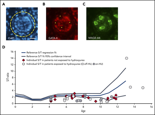 Spermatogonia in the testicular tissue of prepubertal patients with SCD compared with reference values. (A-C) Immunostained section of the testicular tissue of a patient aged 6.1 years who had previously been exposed to hydroxyurea (Off-HU patient 3). (A) Selection of a round tubular cross section (yellow circle). 4′,6-Diamidino-2-phenylindole staining (blue). (B) Expression of GATA-4 nuclear protein in Sertoli cells (red staining). (C) Expression of MAGE-A4 cytoplasmic protein in spermatogonial cells (green staining). Negative images of spermatogonial cells in panel C (yellow triangle). Four spermatogonia could be counted in this selected section. Scale bar = 50 µm. (D) The number of spermatogonia per round tubular cross section (S/T) of patients exposed to hydroxyurea (light gray circle: off-HU; dark gray circle: pon-HU) or not exposed to hydroxyurea (red diamond). Individual S/T values plotted on a meta-regression fit line of S/T reference values during testis development.16 Each mark represents the mean S/T value of a patient. The S/T values of prepubertal patients with SCD were significantly lower than the reference S/T values (Wilcoxon signed-rank test, P<.0001).