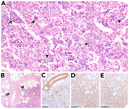 A 57-year-old man with a history of immune thrombocytopenia presented for resection of a 4.2-cm liver mass. Hematologic parameters were within normal limits. Initial pathology evaluation at another institution (panel A; hematoxylin and eosin stain; 20× objective; original magnification ×200) identified markedly numerous myeloid (arrowheads), erythroid (arrow), and megakaryocytic elements (notched arrow), prompting referral for hematopathology consultation, with a preliminary diagnosis of myeloid sarcoma. Histologic examination revealed extensive extramedullary hematopoiesis, fat globules (panel B; arrowhead; hematoxylin and eosin stain; 10× objective; original magnification ×100), and thick-walled, hyalinized blood vessels (arrow). In addition, a proliferation of epithelioid and spindled mesenchymal cells radiated from the vasculature, with coexpression of smooth muscle actin (panel C; 10× objective; original magnification ×100) and the melanocytic markers MART1 (panel D; 10× objective; original magnification ×100) and HMB45 (panel E; 10× objective; original magnification ×100). The patient was diagnosed with a hepatic angiomyolipoma (AML), and further treatment was deferred.