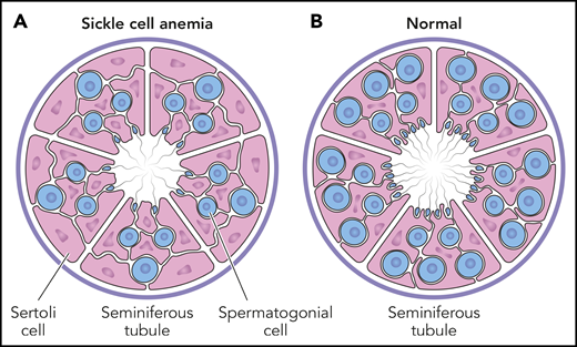 Testicular histology in prepubescent males. The cross-section of a seminiferous tubule contains both spermatogonial progenitor cells (blue) and supportive Sertoli cells (pink). The average number of spermatogonia per tubule (S/T ratio) is significantly less in boys with SCA (A), compared with a normal reference control (B). For boys with SCA, the S/T ratio is not different according to hydroxyurea exposure, indicating that spermatogonial depletion is related to the underlying disease itself, rather than hydroxyurea toxicity. Professional illustration by Patrick Lane, ScEYEnce Studios.