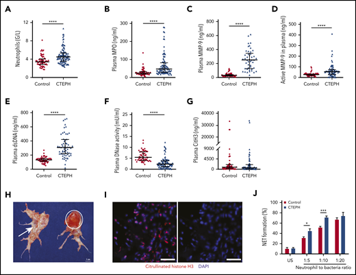 Neutrophil inflammation is common in CTEPH. (A) Circulating blood neutrophil counts: control (n = 60), CTEPH (n = 109); (B) plasma concentrations of MPO: control (n = 60), CTEPH (n = 96), (C) total MMP-9: control (n = 60), CTEPH (n = 46), (D) active MMP-9: control (n = 60), CTEPH (n = 67), (E) extracellular dsDNA: control (n = 60), CTEPH (n = 63), (F) DNase activity: control (n = 57), CTEPH (n = 103), and (G) circulating CitH3: control (n = 60), CTEPH (n = 77). (H) Macroscopic view of thrombus excised during pulmonary endarterectomy representing fresh (red; circle) and organized (white; arrow) material. (I) Immunofluorescence staining for CitH3 in fresh red CTEPH thrombus (scale bars, 50 µm). Data in panels A-G are shown as median and interquartile ranges. (J) Ex vivo NET formation in healthy controls (n = 5) and in patients with CTEPH (n = 6) after coincubation with S aureus. Data are shown as mean ± SEM. *P < .05; ***P < .001 (unpaired Student t test); ****P < .0001 (Mann-Whitney U test). US, unstimulated.