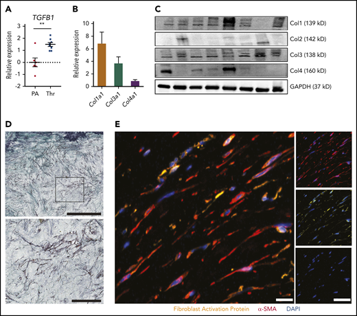 Fibrotic remodeling of CTEPH thrombi. (A) qPCR analysis for TGFB1 expression in CTEPH thrombus (Thr) (n = 8) and nonthrombosed pulmonary artery (PA) (n = 6). (B) qPCR analysis (n = 22) and (C) immunoblotting (n = 8) for different collagen types in CTEPH thrombus. Glyceraldehyde-3-phosphate dehydrogenase (GAPDH) was chosen as a housekeeping protein. (D) Representative trichrome staining of CTEPH thrombus (scale bar, 200 µm) and magnification of the boxed area shows fibroblast-like cells (scale bar, 100 µm). (E) Merged immunofluorescence staining for α-SMA (red) and FAP (yellow) of CTEPH thrombus; single-channel images are shown on the right (scale bars, 20 µm). Data in panel A are shown as mean ± SEM. **P < .01 (unpaired Student t test).