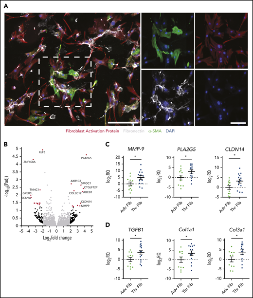 Transcriptome profiling of CTEPH thrombus fibroblasts. (A) Immunofluorescence staining of fibroblasts isolated from CTEPH thrombus for FAP (red), matrix protein fibronectin (white), and α-SMA (green), with DAPI as the nuclear stain. Left: lower magnification (scale bar, 100 µm); right: higher magnification (scale bars, 20 µm) of the boxed area with single-channel images. (B) Volcano plot illustrating fold differences in gene expression (genes with fold change ≥2 are highlighted in red, black dots represent genes with nonsignificant expression differences, and gray dots show genes with a fold change of <2) of thrombus fibroblasts and corresponding adventitial fibroblasts from CTEPH patients (n = 4). (C) qPCR validation of 3 upregulated genes and (D) TGF-β pathway–associated genes in a larger cohort (n = 11-14). Data are shown as mean ± SEM. Adv Fib, adventitial fibroblasts; Thr Fib, thrombus fibroblasts; CLDN14, Claudin 14; PLA2G5, phospholipase A2 Group V. *P < .05 (unpaired Student t test).